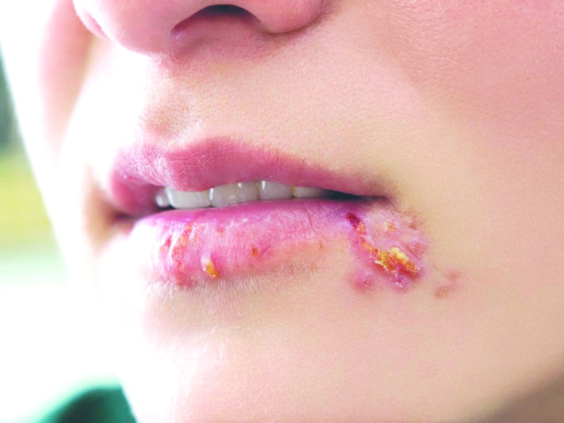 Mọc mụn nước ở môi là biểu hiện của bệnh lý do nhiễm virus Herpes hoặc phun xăm thẩm mỹ kém chất lượng